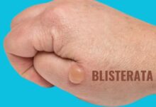 Blisterata